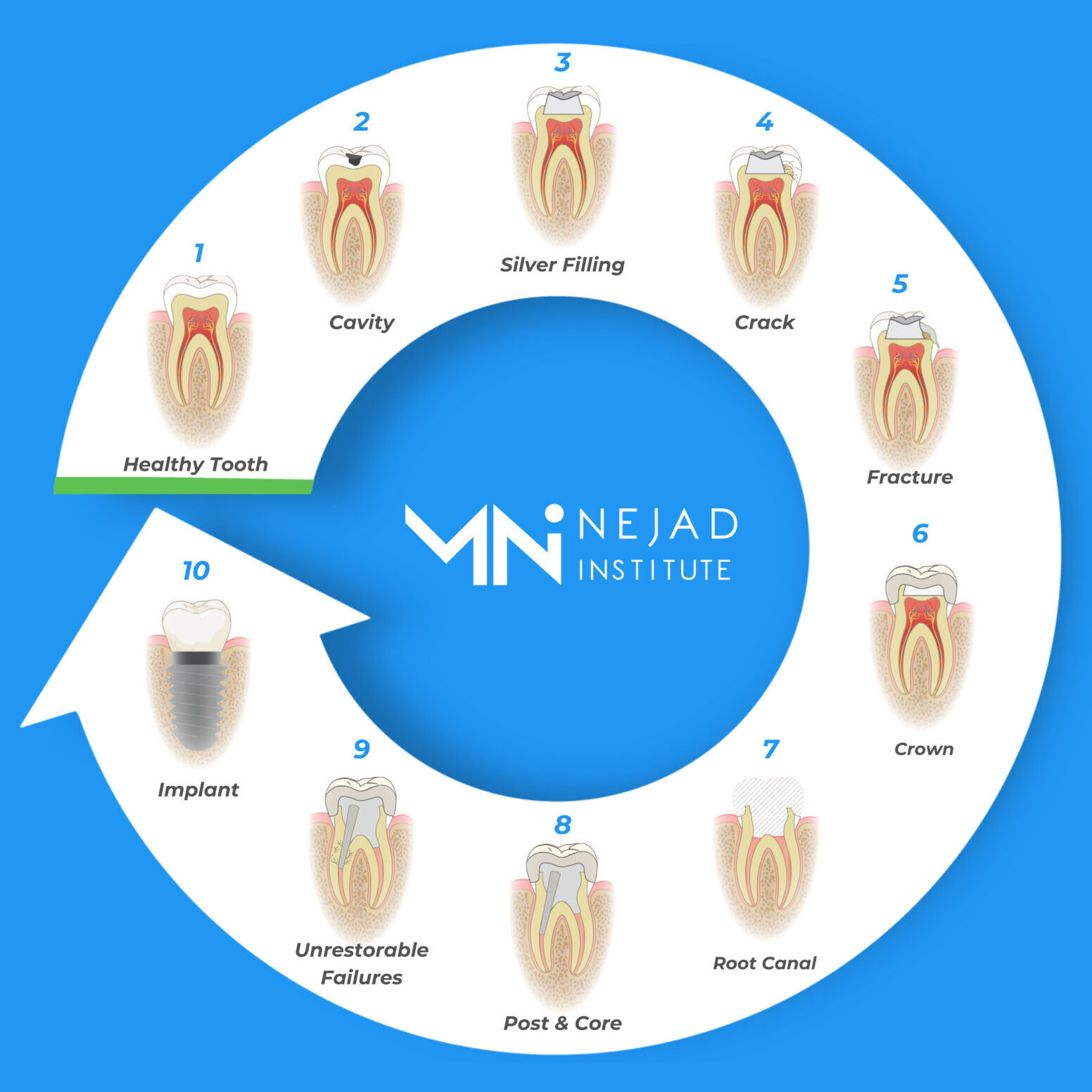 The Tooth Cycle Of Death - Nejad Institute For Biomimetic Dentistry