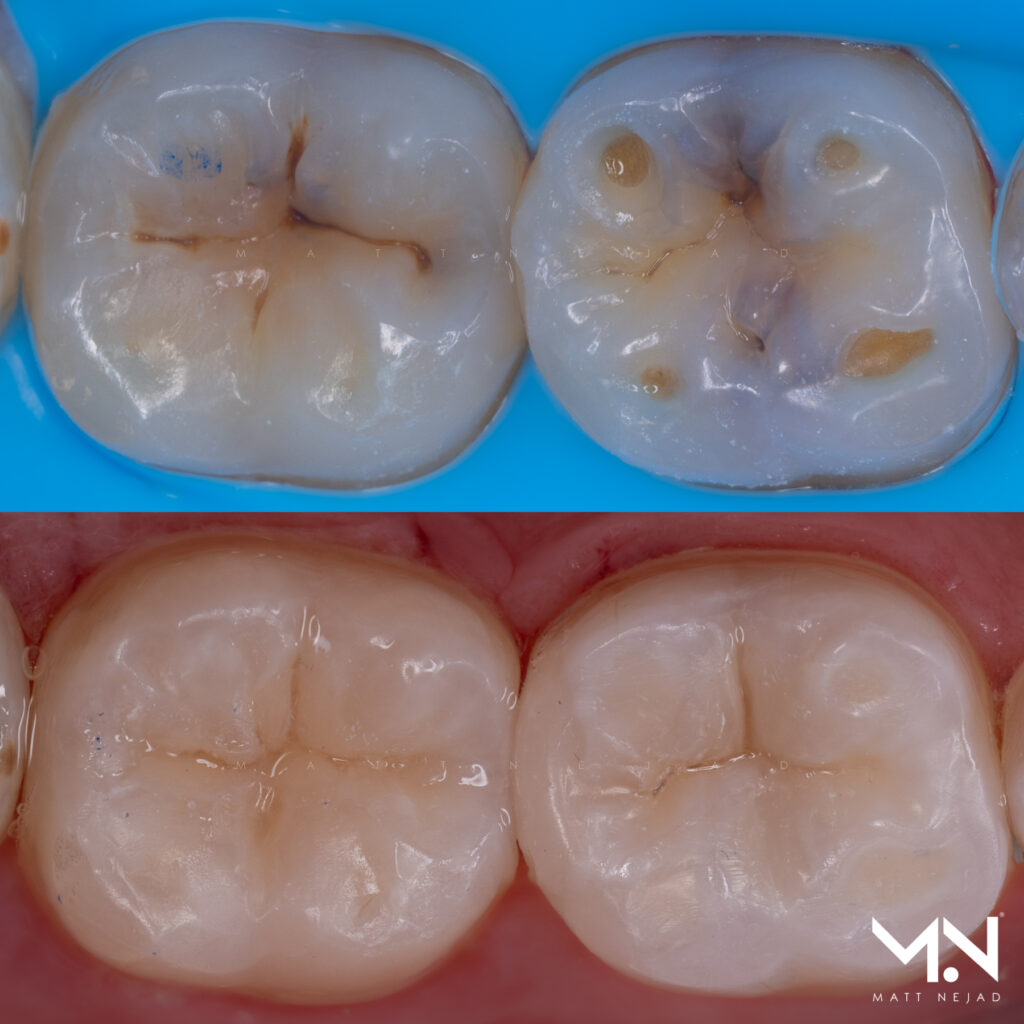 Before and after Biomimetic direct composite restorations