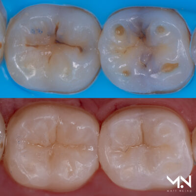 Before and after Biomimetic direct composite restorations