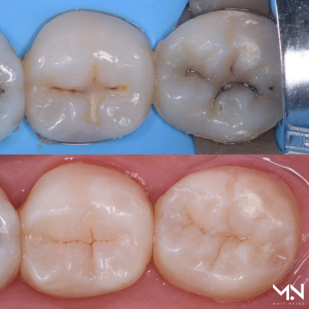 Before and after Biomimetic direct composite restorations