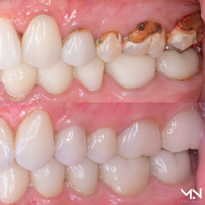 Full Mouth Rehabilitations with biomimetic approach