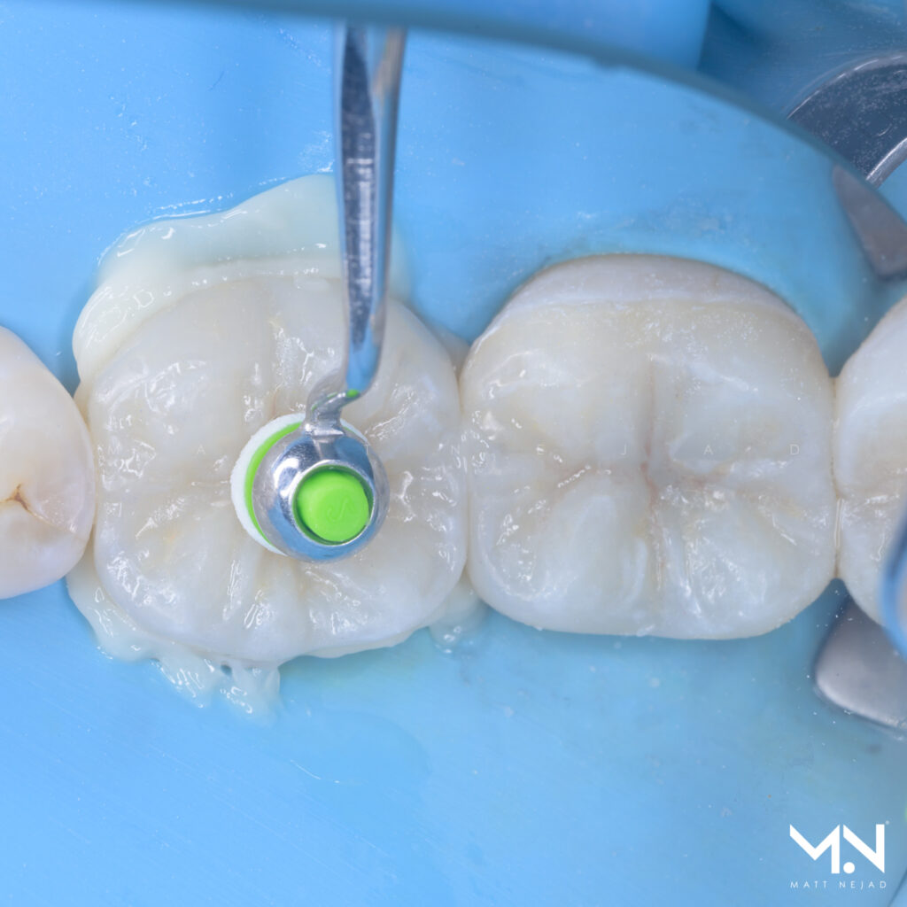 Using heated composite for cementation of onlay restorations