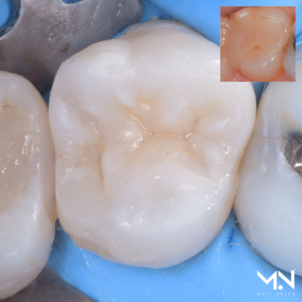 Biomimetic Inlay Before and After