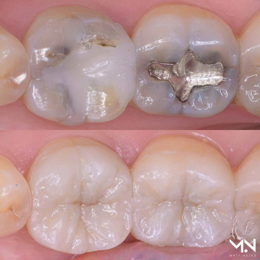 Natural Biomimetic Onlay Restorations used to restore symptomatic teeth.