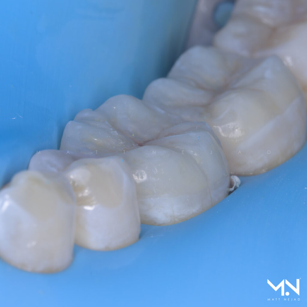 Biomimetic restorations can have seamless margins